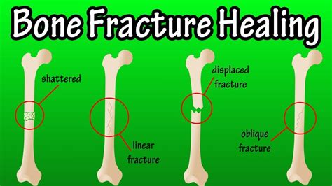 Can a fracture heal in 2 weeks?