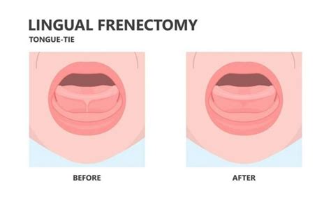 Can a frenectomy go wrong?
