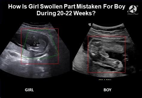 Can a girl be mistaken for a boy at 20 weeks?