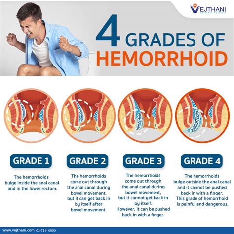Can a grade 3 hemorrhoid go away without surgery?
