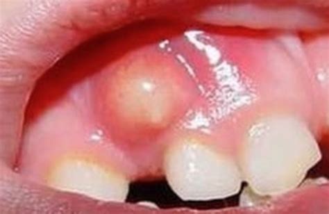 Can a gum cyst be hard?