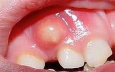 Can a gum cyst heal on its own?