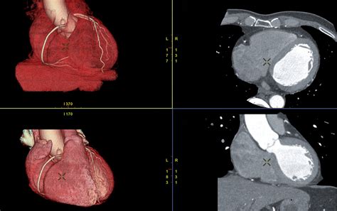 Can a heart CT scan be wrong?