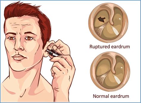 Can a hole in eardrum be repaired?