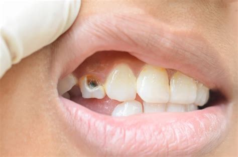 Can a hole in tooth at gum line be fixed?