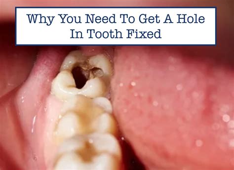 Can a hole in tooth close naturally?