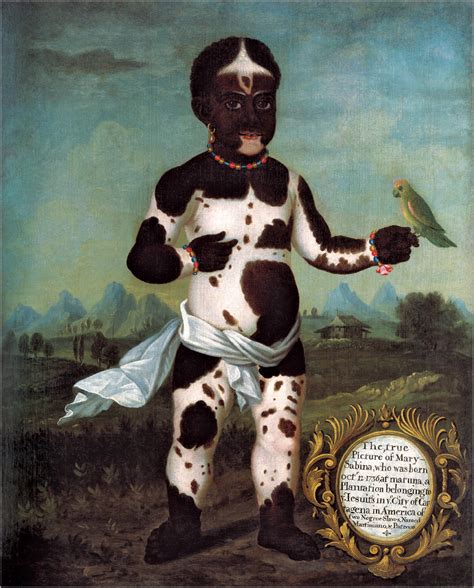 Can a human be piebald?