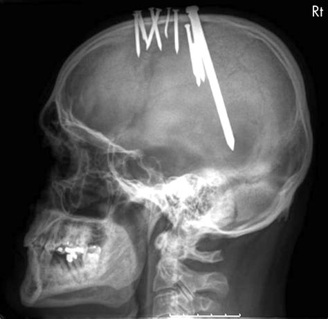 Can a human skull withstand a bullet?