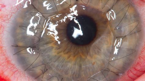 Can a living person donate cornea?