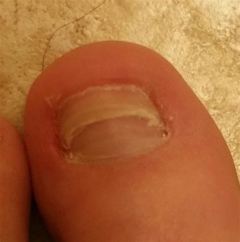 Can a new toenail grow under another?