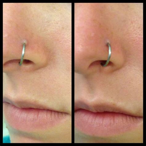 Can a nose ring heal in 2 months?