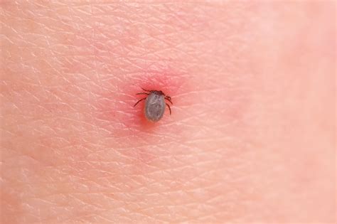 Can a person be immune to ticks?