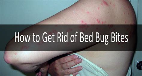 Can a person become immune to bed bug bites?