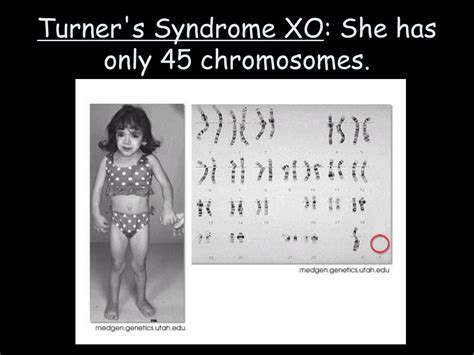Can a person have 45 chromosomes?