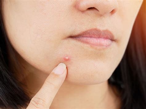 Can a pimple never heal?