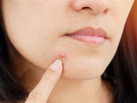 Can a pimple stay for 2 months?