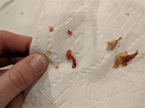 Can a polyp burst and bleed?