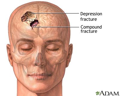 Can a punch fracture a skull?