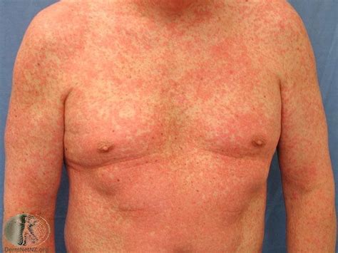 Can a rash go away in 3 days?