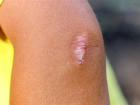 Can a scar hurt 20 years later?