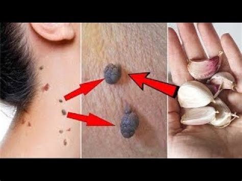 Can a skin tag pop up overnight?