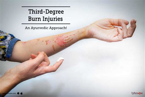 Can a small 3rd degree burn heal on its own?