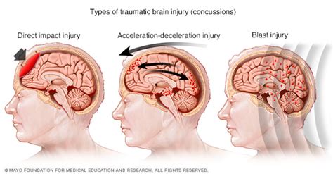Can a small fall cause concussion?