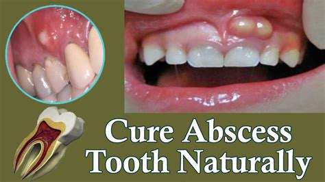 Can a small gum abscess heal itself?