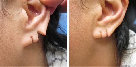 Can a split ear heal?
