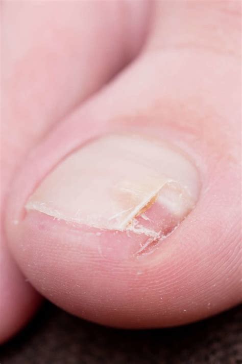 Can a split nail be fixed?