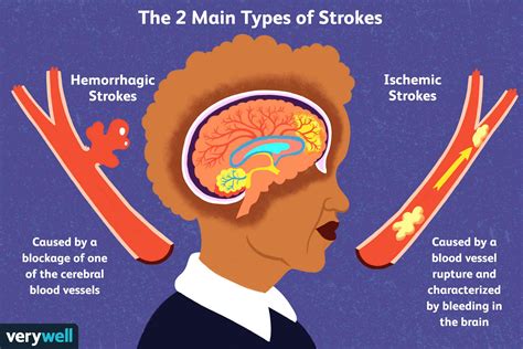 Can a stroke cause weird smells?