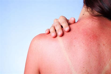 Can a sunburn heal in 2 days?