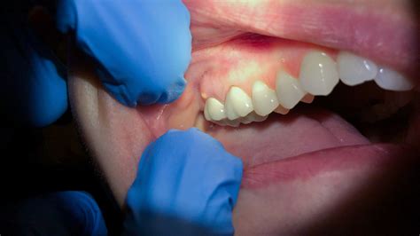 Can a tooth abscess wait a week?
