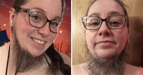 Can a woman be hairy without PCOS?