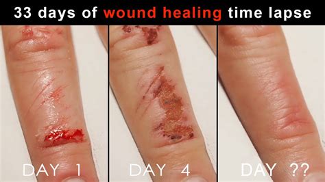 Can a wound still bleed after being glued?