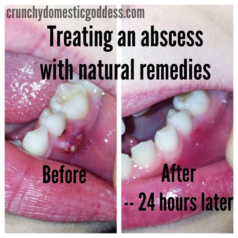 Can abscess heal without draining?