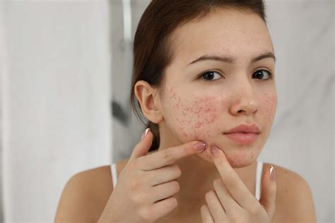 Can acne be permanent?