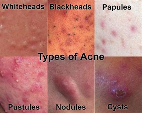 Can acne last for 10 years?