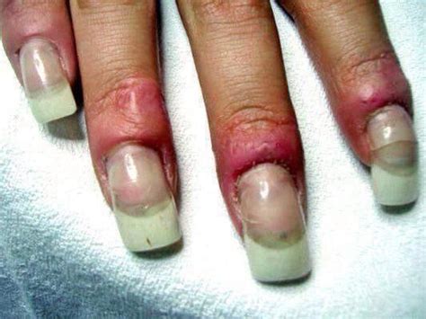 Can acrylic cause infection?