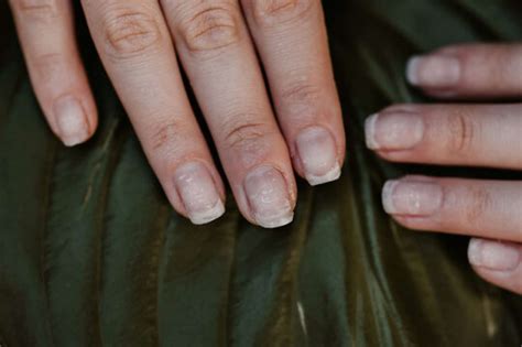 Can acrylic nails cause acne?
