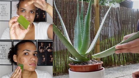 Can aloe vera clear pimples?