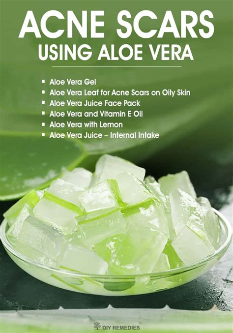 Can aloe vera remove acne scars?