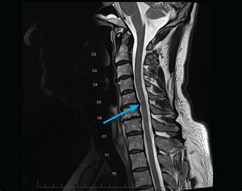 Can an MRI miss nerve damage?