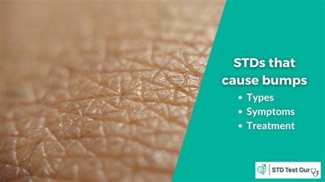 Can an STD live on your hand?
