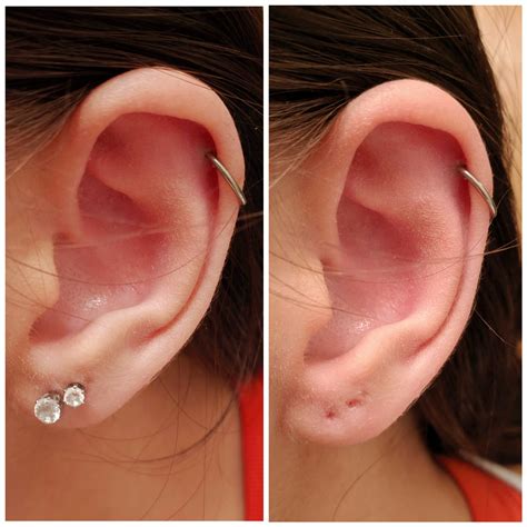 Can an ear piercing close overnight?