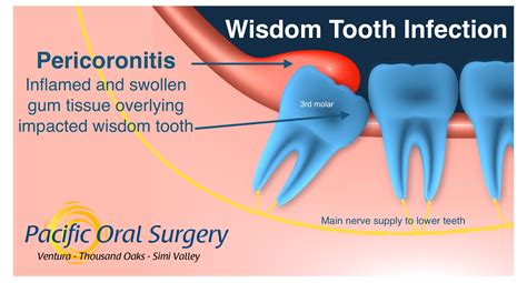 Can an infected wisdom tooth get better on its own?