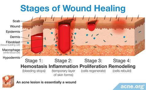 Can an infected wound heal on its own?