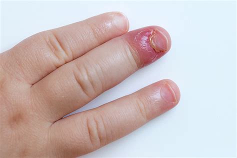 Can an infection in your finger make you feel sick?