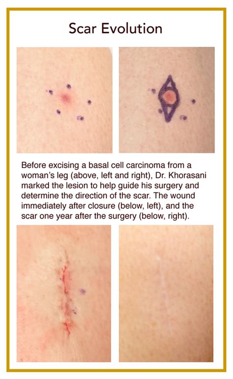 Can an old scar turn cancerous?