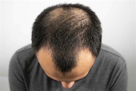 Can androgenetic alopecia regrow hair?